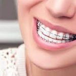 Your Guide To Metal Braces - Everything You Need To Know