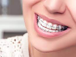 Your Guide To Metal Braces - Everything You Need To Know